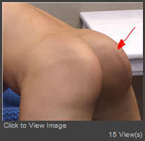 Buttock.JPG